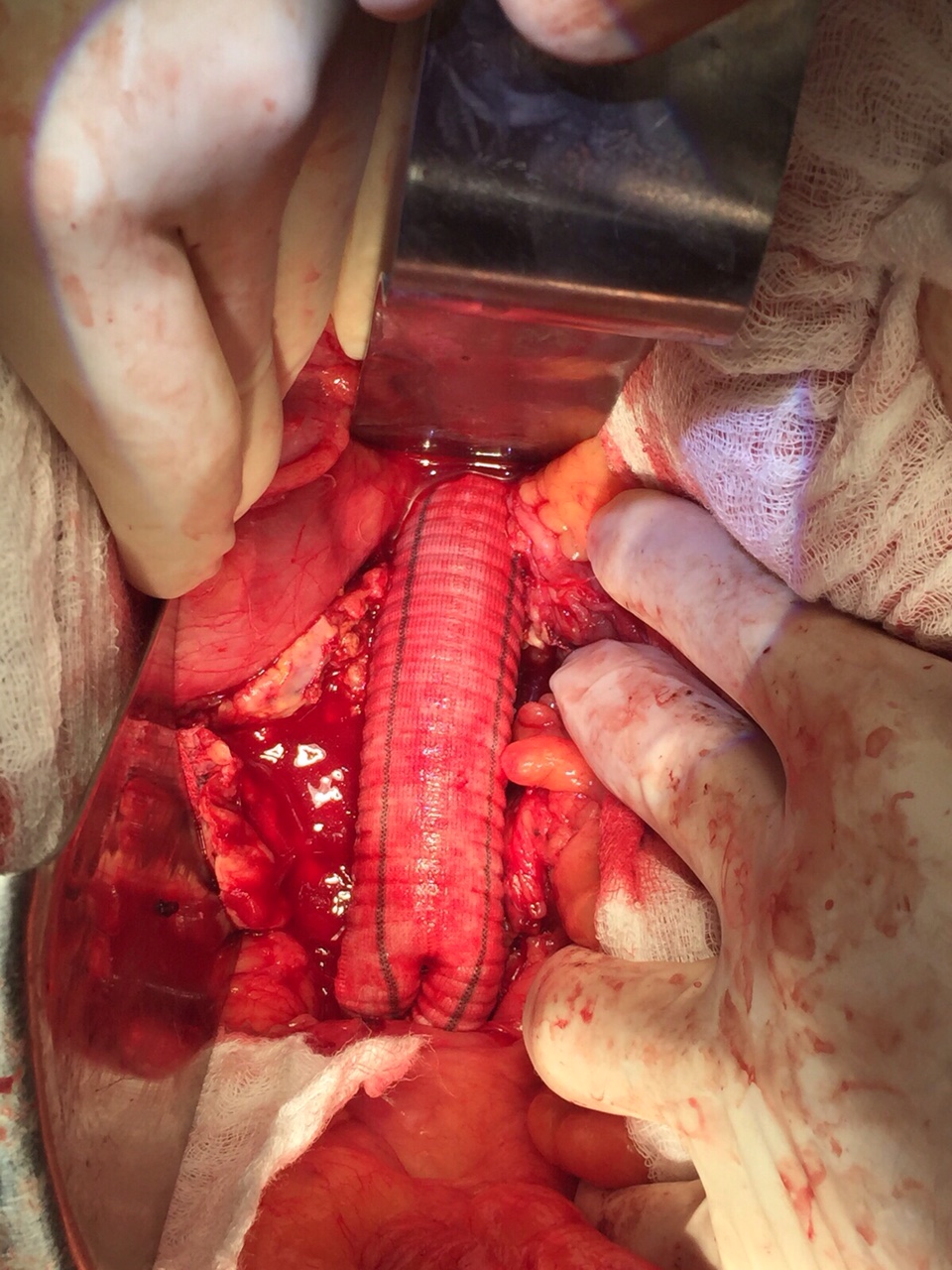 Cirurgia de aneurisma de aorta é realizada com sucesso no Socorrão I